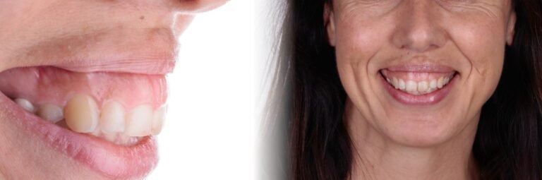 CORRECTION DU SOURIRE GINGIVAL ET APPORT DE LA PROTHÈSE SOUS-NASALE : LE BIOVOLUME